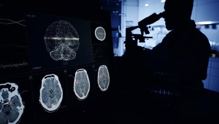 Alzheimer araştırmalarında şok! 16 yıllık makale tartışma yarattı… Yüzlerce çalışma çöpe mi gidecek?